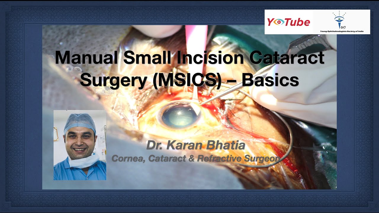 Small Incision Cataract Surgery Video Download
